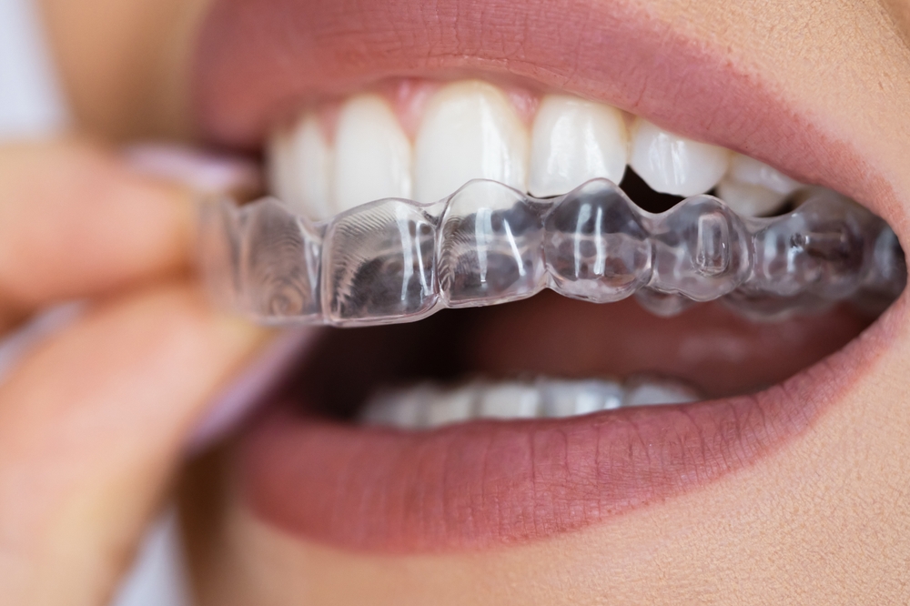 Person placing a transparent ClearCorrect aligner over their upper teeth