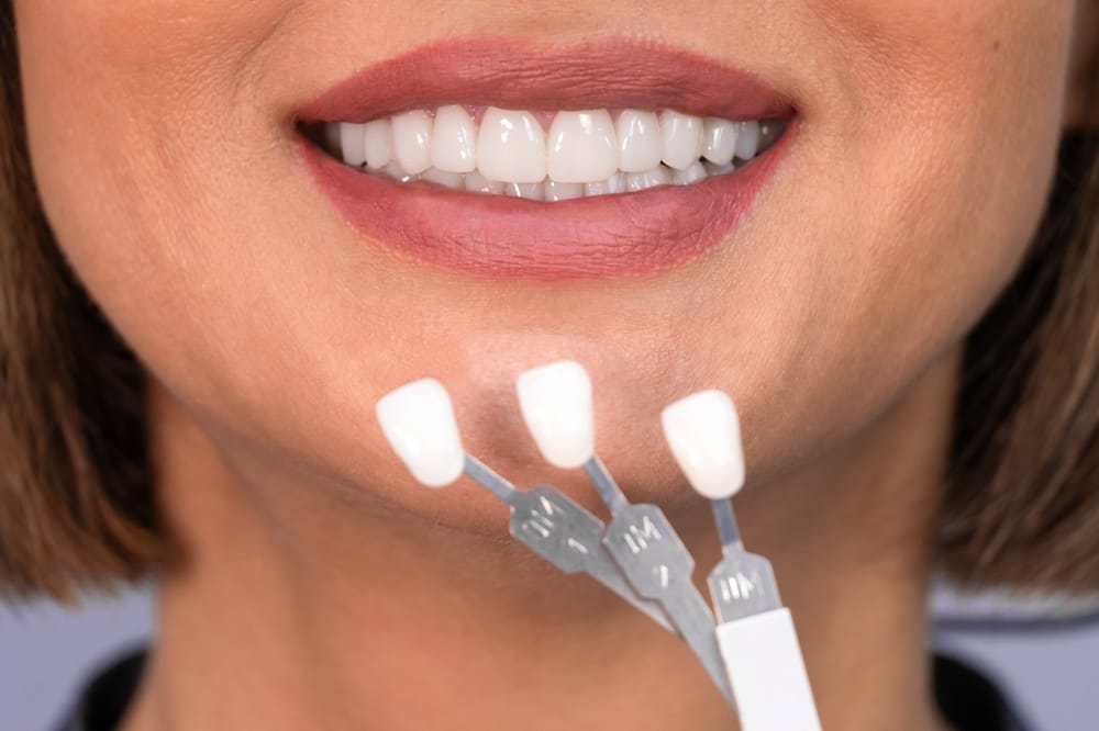 Whitening concept. Dental care, implants for veneers. Beautiful caucasian woman with perfect smile chooses tooth tone in dental clinic. Modern medicine.