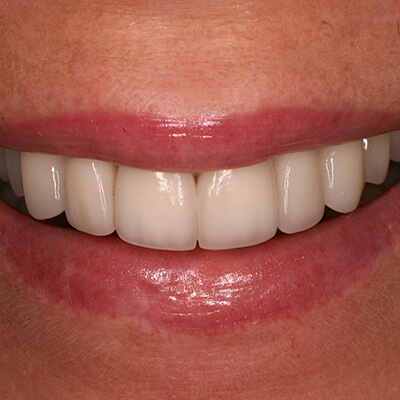 Close-up of an even, bright smile after customized cosmetic dental treatment