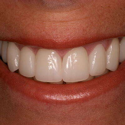 Close-up of a restored smile with natural-looking front teeth