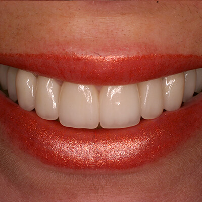 Close-up of a smile with straight white teeth and red lipstick