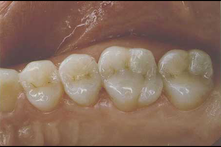 Teeth restored with tooth-colored composite resin inlays and onlays