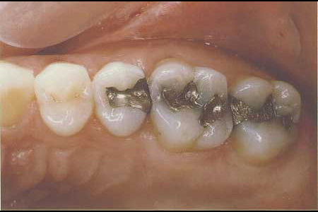 Deteriorating metal fillings before treatment