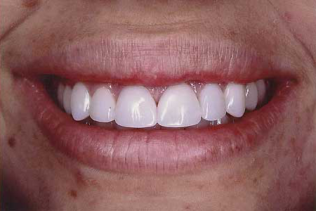 Smile after composite resin veneers
