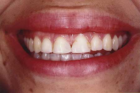 Front teeth before composite resin veneers
