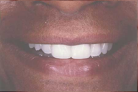 Front tooth gap closed with composite resin veneers