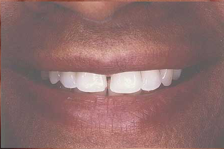 Smile with a gap between the front teeth