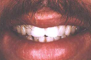 Fractured front tooth restored with an all-porcelain veneer