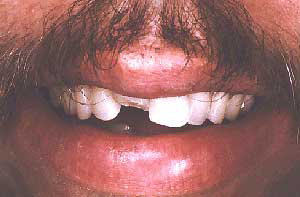 Fractured front tooth before treatment