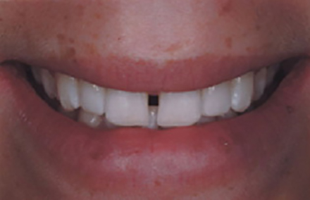 Close-up of a smile with a visible gap between the upper front teeth