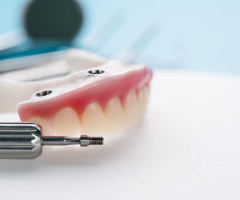 Full-arch denture model with implant attachment holes next to a metal implant tool