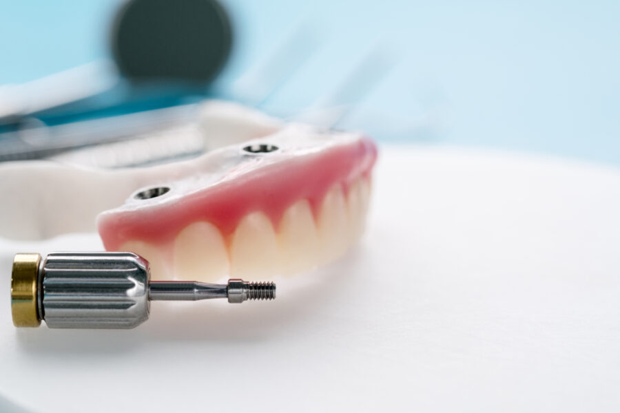 Full-arch denture model with implant attachment holes next to a metal implant tool