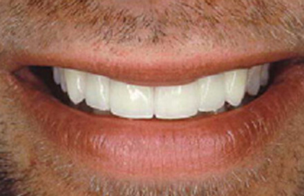 Smile after porcelain veneer-crowns and an all-porcelain bridge