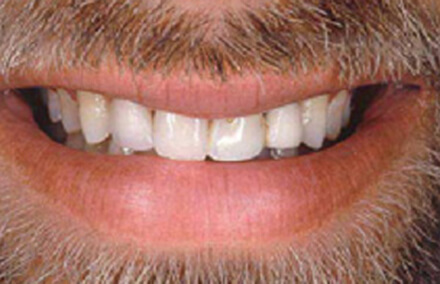 Smile with an unstable upper front bridge before treatment