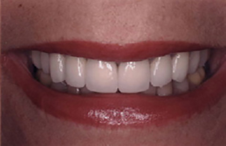 Brighter smile after porcelain-to-gold crown treatment
