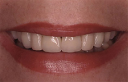 Smile with older yellowed crowns before treatment