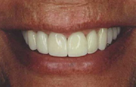 Smile after porcelain crowns and veneers