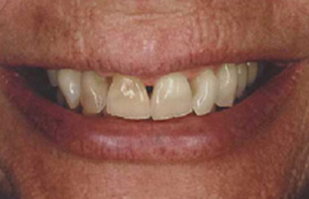 Smile with worn, discolored teeth before treatment