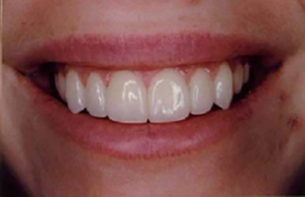 Smile after porcelain veneers were placed on the front eight teeth