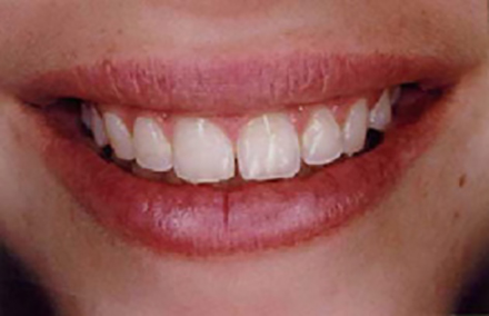 Smile before porcelain veneers following orthodontic treatment