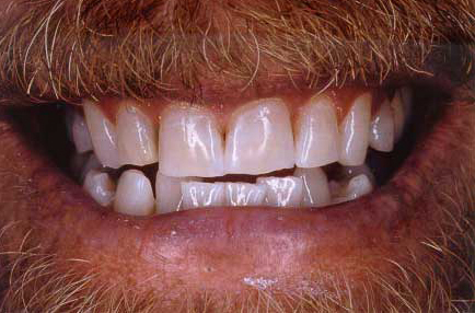Brighter smile after professional teeth whitening
