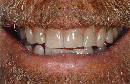 Smile before professional teeth whitening