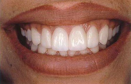 Worn front teeth restored with porcelain veneer-crowns