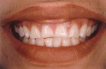 Extremely worn front teeth before treatment